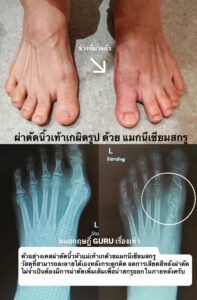 ภาพเปรียบเทียบเท้าทั้งสองข้างของผู้ป่วยนิ้วหัวแม่เท้าเก โดยเท้าด้านขวามีลูกศรชี้ว่าเป็นข้างที่ผ่านการผ่าตัดแล้ว พร้อมภาพเอ็กซเรย์ด้านล่างแสดงผลหลังการผ่าตัดด้วยแมกนีเซียมสกรู ซึ่งสามารถละลายได้เอง ลดการเสียดสี และไม่ต้องผ่าตัดซ้ำเพื่อนำสกรูออก
