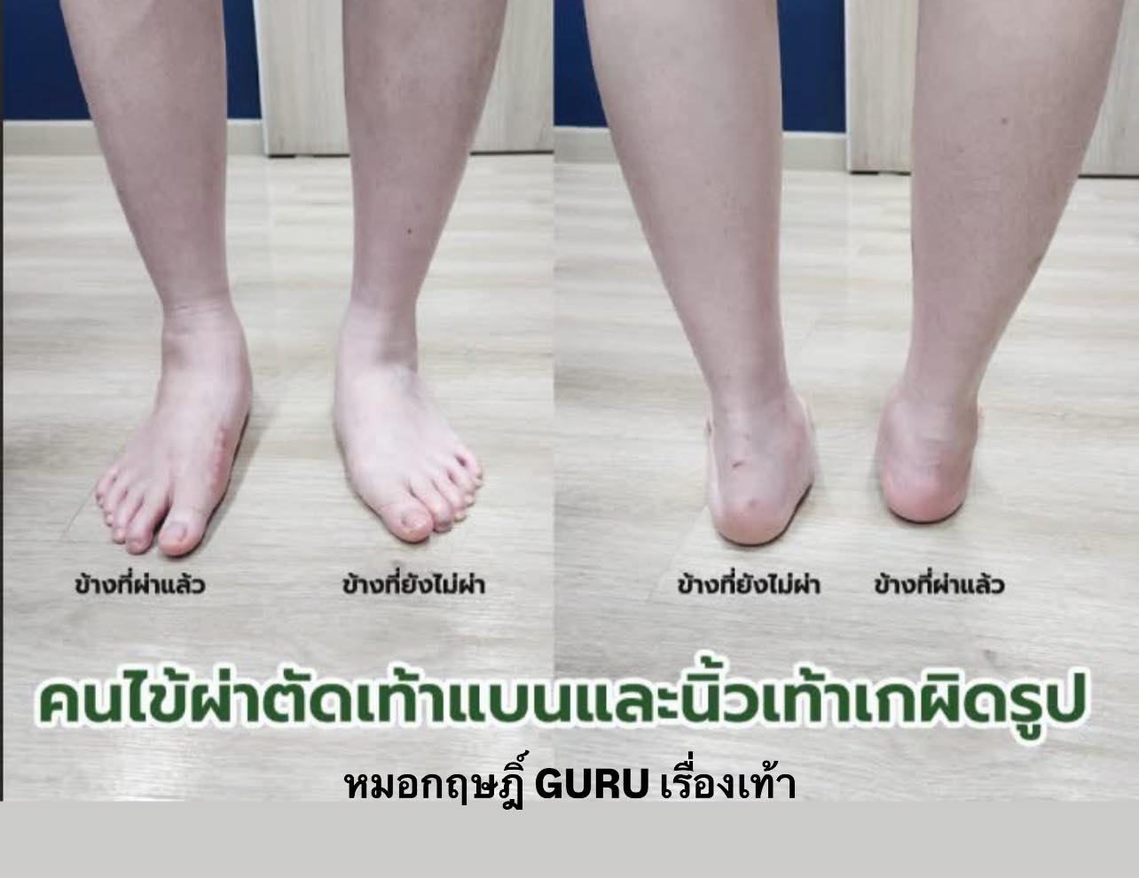 ภาพเปรียบเท้าข้างที่ผ่าตัดแล้วกับข้างที่ยังไม่ได้ผ่าในผู้ป่วยเท้าแบนและนิ้วหัวแม่เท้าเกผิดรูป