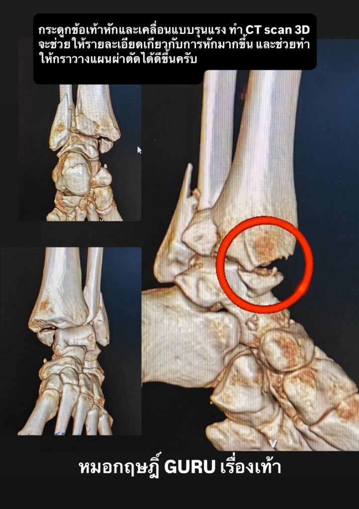 ภาพ CT Scan 3D แสดงกระดูกข้อเท้าหักและเคลื่อนอย่างรุนแรง เห็นตำแหน่งรอยหักชัดเจน