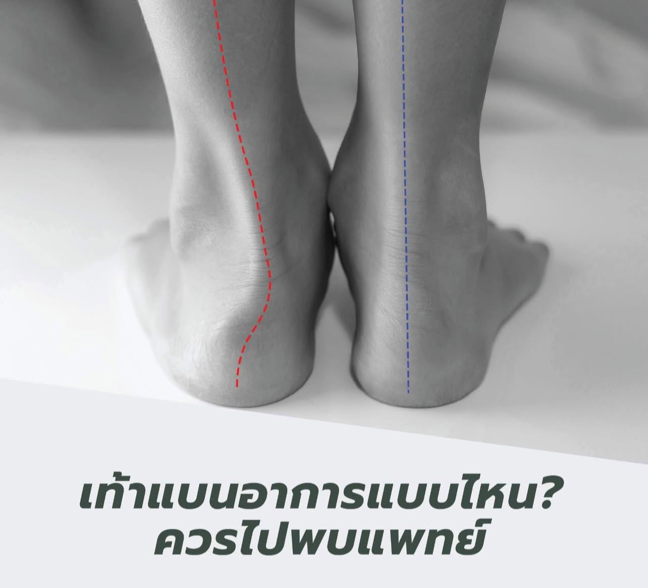 เท้าแบนแบบไหนควรไปพบแพทย์?