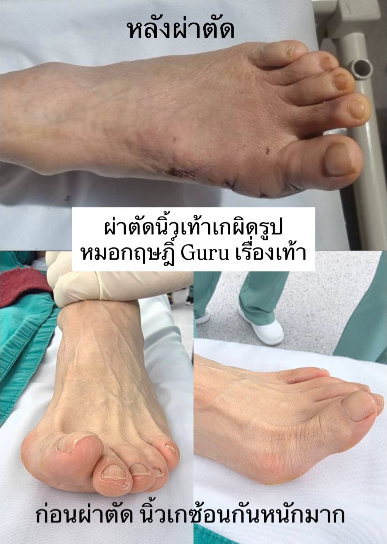 ผ่าตัดนิ้วหัวแม่เท้าเกผิดรูปด้วยเทคนิคแผลเล็ก ทางเลือกที่ช่วยให้ฟื้นตัวได้เร็วขึ้นในบางเคส