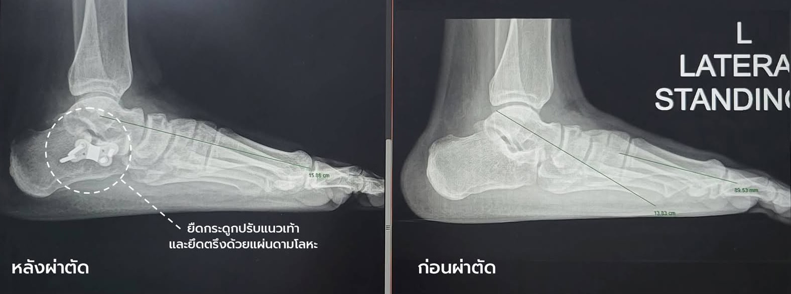 ภาพเอกซเรย์เท้าซ้ายด้านข้างขณะยืน ก่อนและหลังผ่าตัดเท้าแบน