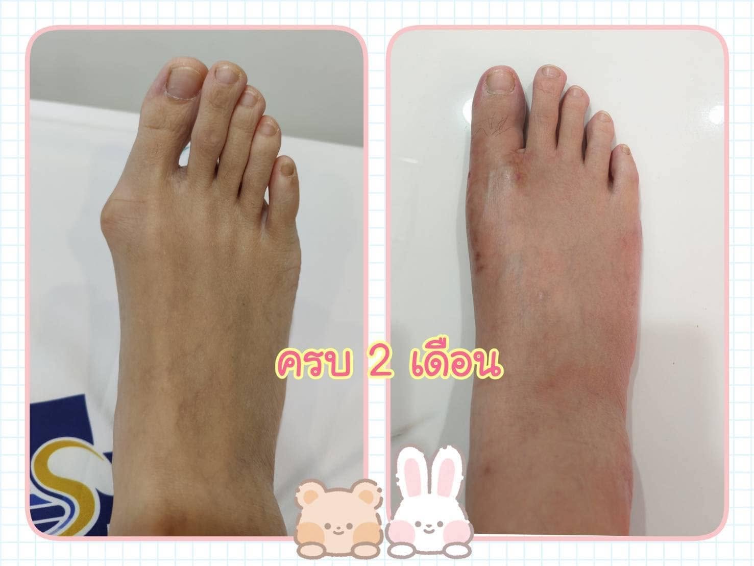 หมอเล่าเคส ผ่าตัดรักษานิ้วโป้งเท้าเกผิดรูป (Hallux Valgus)
